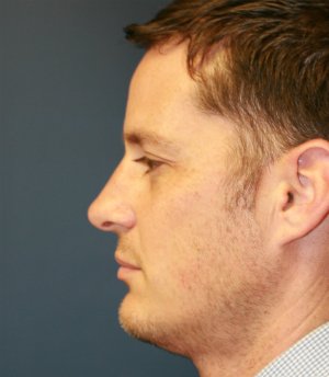 Rhinoplasty (nose re-shaping) 50 - before - side