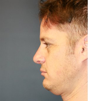 Rhinoplasty (nose re-shaping) 50 - after - side