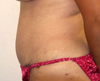 Tummy Tuck Case 20 - after - side