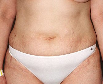Tummy Tuck Case 21 - before - front