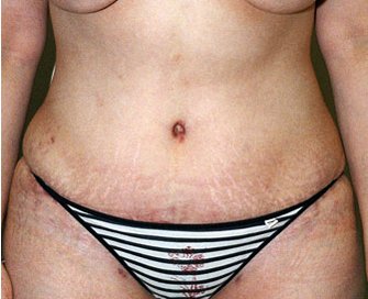 Tummy Tuck Case 21 - after - front