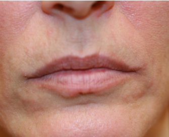 Juvederm in Lips, One Milliliter - before - front
