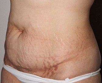 Tummy Tuck Case 21 - before - angle
