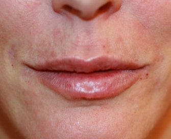 Juvederm in Lips, One Milliliter - after - front