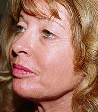 Facelift Case 5 - before - angle