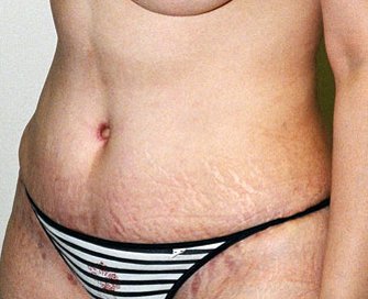 Tummy Tuck Case 21 - after - angle