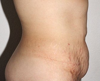 Tummy Tuck Case 21 - before - side