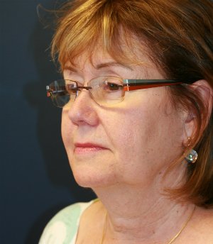 Neck and Lower Face Lift - before - oblique