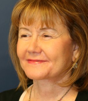 Neck and Lower Face Lift - after - oblique