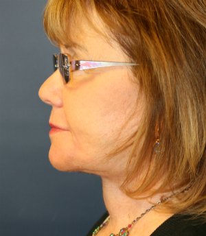 Neck and Lower Face Lift - after - front