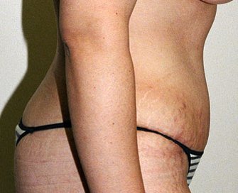 Tummy Tuck Case 21 - after - side