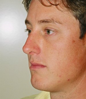 Rhinoplasty Case 12 - after - oblique