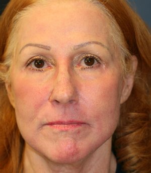 Laser Skin and Jowl Removal - after - front