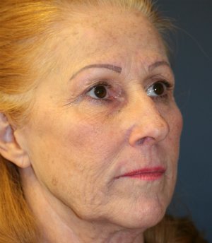 Laser Skin and Jowl Removal - before - oblique