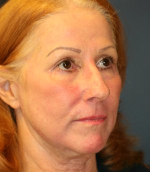 Laser Skin and Jowl Removal - after - oblique