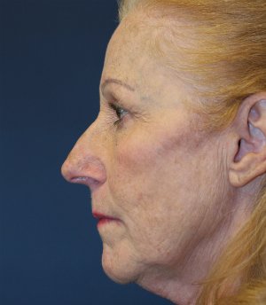 Laser Skin and Jowl Removal - before - side