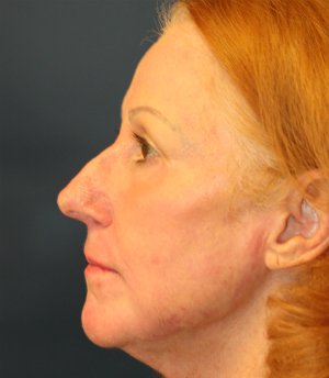 Laser Skin and Jowl Removal - after - side