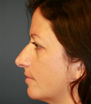 Rhinoplasty San Diego 45 - before - front