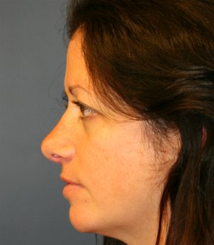Rhinoplasty San Diego 45 - after - front