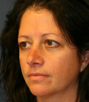 Rhinoplasty San Diego 45 - after - oblique