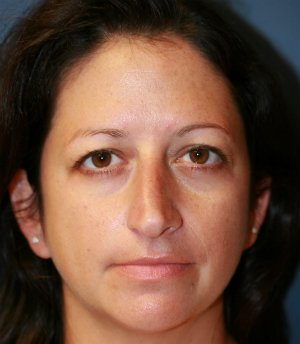 Rhinoplasty San Diego 45 - before - side