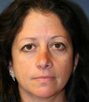 Rhinoplasty San Diego 45 - after - side