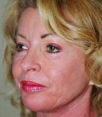 Facelift Case 5 - after - angle