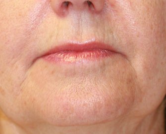 Lip Corners & Laser Rx - before - front