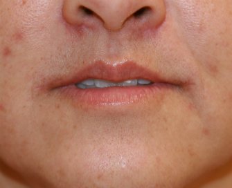 Corner Lip Lift (Sad to Pleasant) - after - front