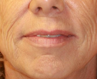Laser of Lips and Corner Lift - before - front
