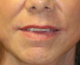 Laser of Lips and Corner Lift - after - front