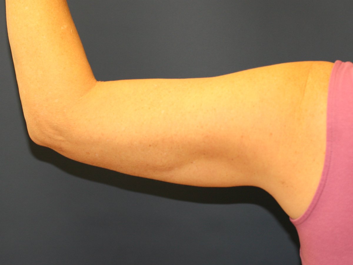 Thermi to Arms - before - front