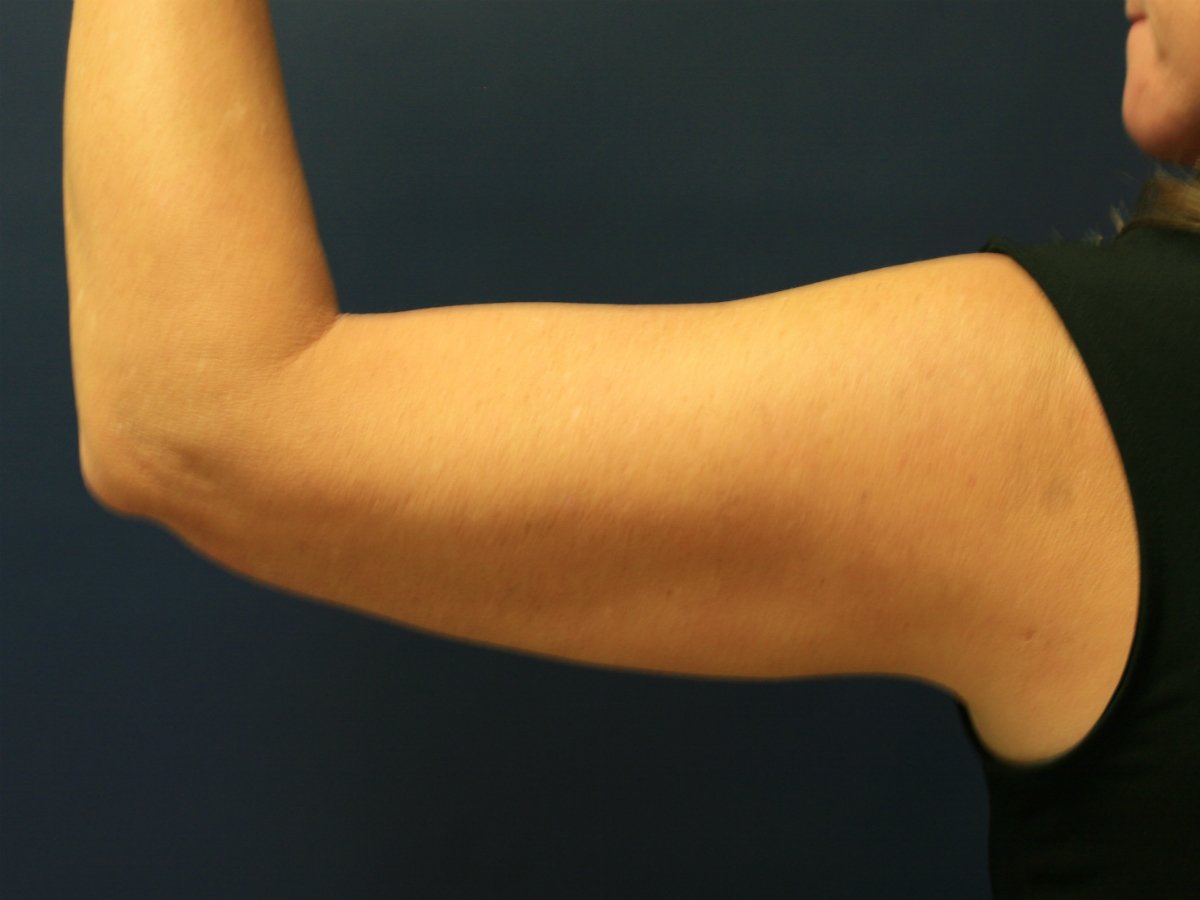 Thermi to Arms - after - front