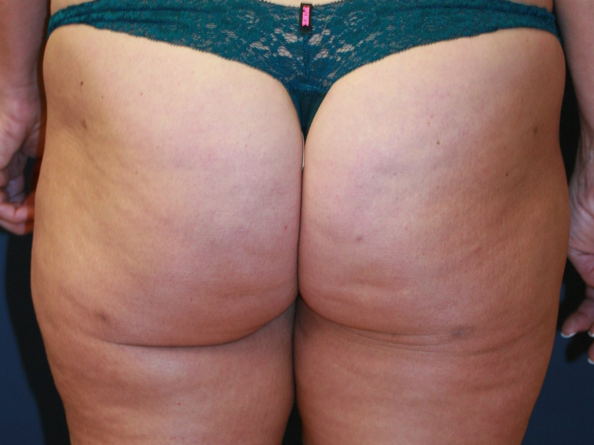 Buttock Cellulite - before - front