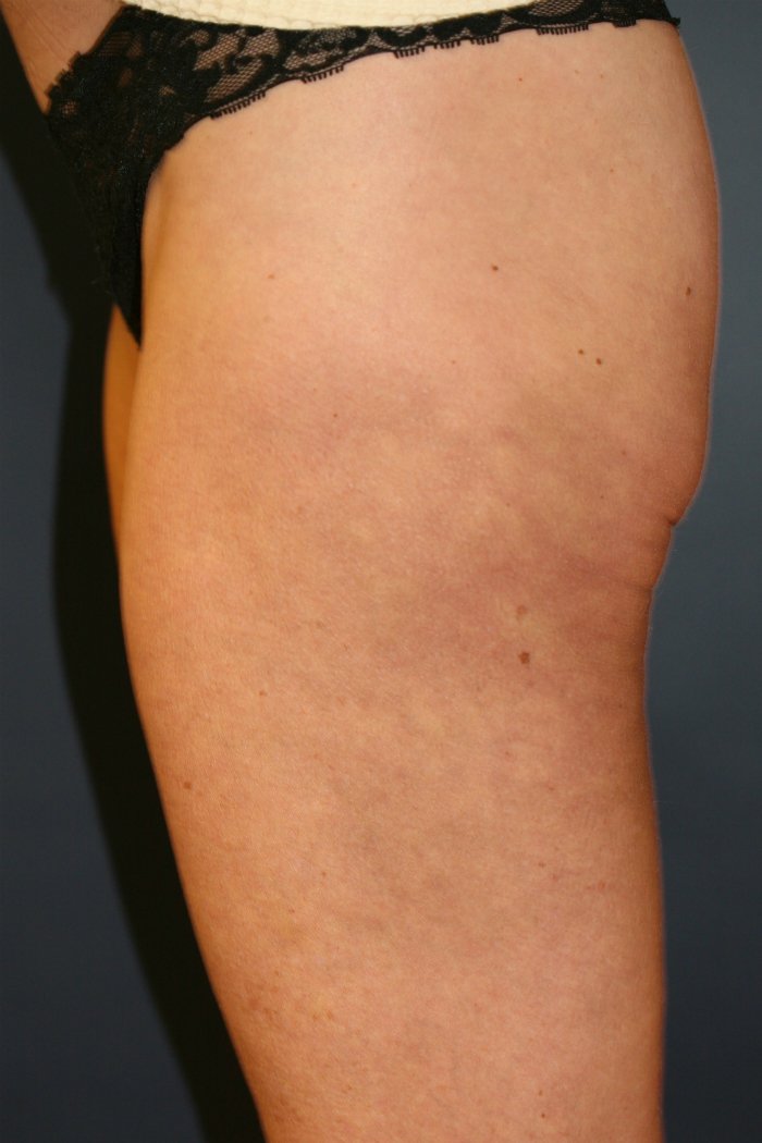 Thigh Cellulite Thermi-RF treatment - after - front