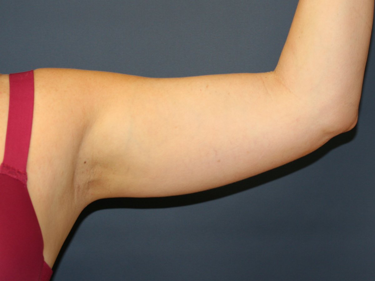 Arm Liposuction plus Skin Tightening - before - front