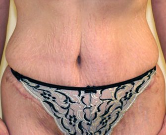 Tummy Tuck Case 24 - after - front