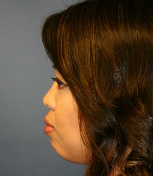 Rhinoplasty San Diego 47 - before - side