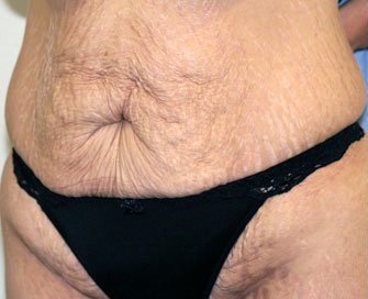 Tummy Tuck Case 24 - before - angle
