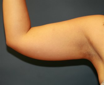 Liposuction Right Arm - before - front