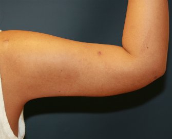 Liposuction Right Arm - after - back