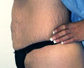 Tummy Tuck Case 24 - before - side