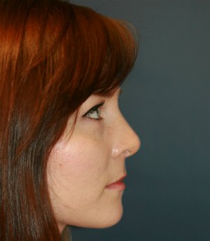 Remove Bump on Nose San Diego - after - front