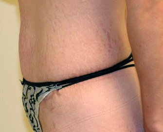 Tummy Tuck Case 24 - after - side