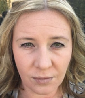 Before and After Botox Selfies - before - front