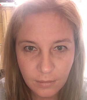 Before and After Botox Selfies - after - front