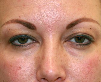 Blepharoplasty Case 11 - before - front