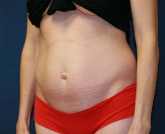tummy-tuck-san-diego-73 - before - oblique