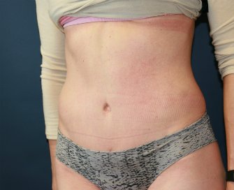 tummy-tuck-san-diego-73 - after - oblique