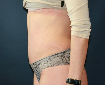 tummy-tuck-san-diego-73 - after - side